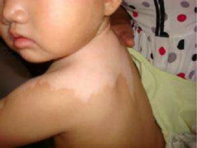 散发型白癜风科