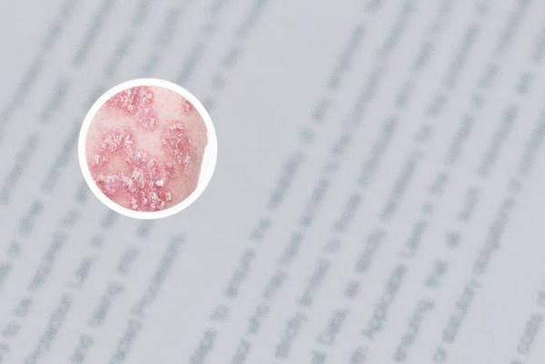 长春银屑病的治疗去哪里好-长春银屑病医院电话号码