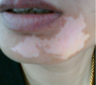 长春博润皮肤病医院的具体地址-长春市白癜风医院