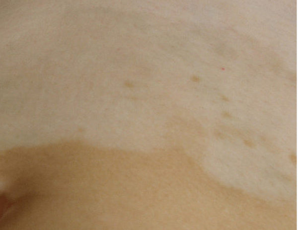 长春博润医院离哪个火车站近-长春白癜风医院哪所正规