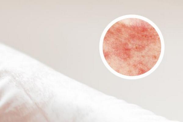 长春找博润专注治疗皮肤病-长春哪个医院看银屑病好