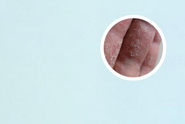 长春博润皮肤病医院消费高吗-长春银屑病治疗效果好医院