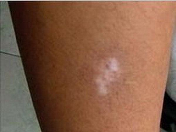 长春治白癜风博润搞得定-长春白癜风专业医院的地址