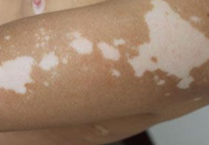 长春银屑博润很可靠-长春市哪家医院治疗白癜风好