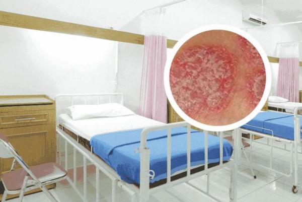 长春专业银屑病医院哪里好-长春去哪家治银屑病