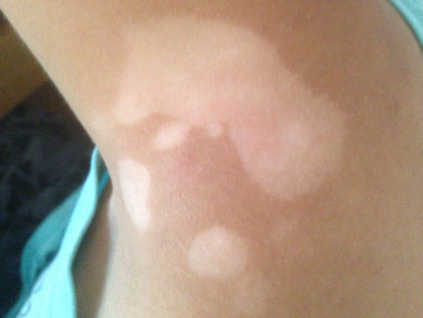 长春哪个医院看白癜风疗效好-长春专业白癜风医院的地址在哪里