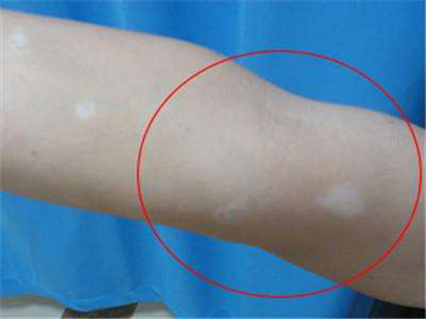 长春治疗白癜风医院效果如何-长春哪家医院看白癜风比较好