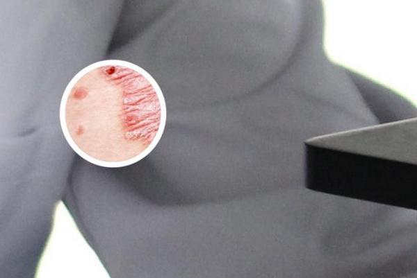 长春看银_博润杰出-长春银屑病医院官网