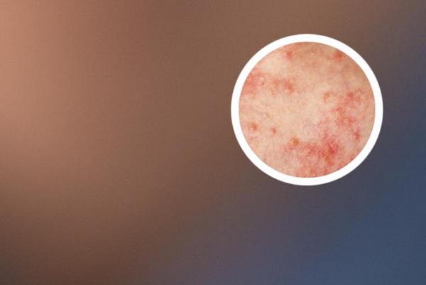 长春博润医院收费高吗-长春市银屑病医院地址在什么位置