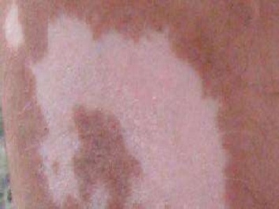 长春好白癜风医院在哪里-长春白癜风治疗好专业医院