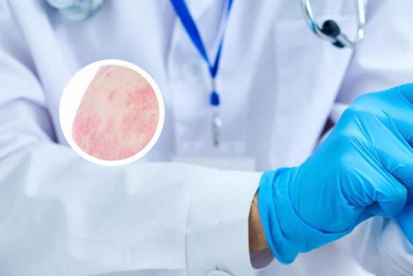 长春哪家医院治疗银屑病有效-在长春看银屑病哪个医院治的好