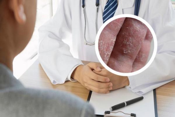 长春看银博润皮肤病医院专业正规-长春哪家医院看银屑病专业