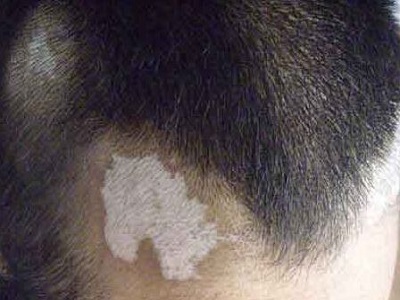 长春博润皮肤病医院好吗-长春看白癜风哪家好