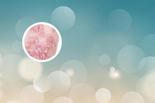 长春治银博润靠谱-长春白癜风治疗好的专业医院