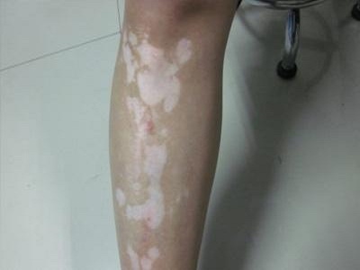 长春哪家医院治白癜风专业-长春去哪里治疗白癜风有效果