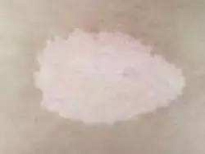 长春博润皮肤病医院的评价-长春哪所医院治白癜风好