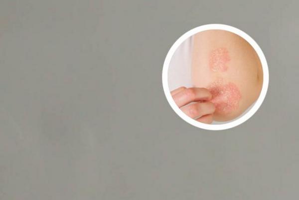 在长春看银屑病哪个医院治疗好-长春哪家医院治银屑病疗效好