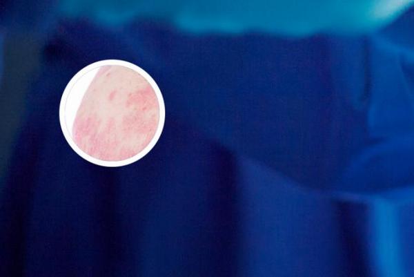 长春博润皮肤病医院的专家号-长春哪个医院治疗银屑病疗效好