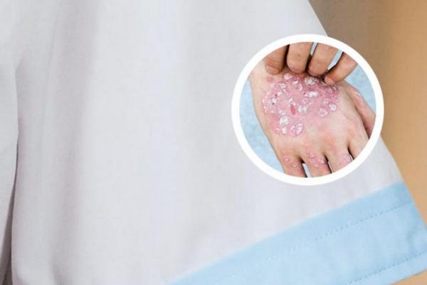 长春有哪些治银屑病医院-长春治疗银屑病好医院