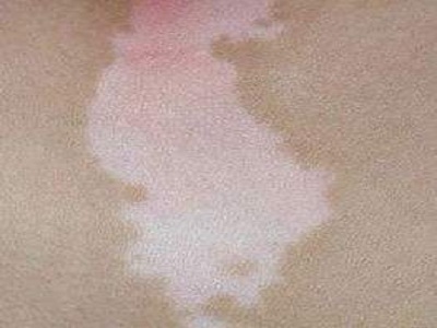 长春什么医院白癜风看的好-长春治疗白癜风好的医生