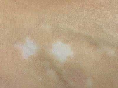 长春哪里可以医白癜风-长春白癜风哪个医院冶疗好