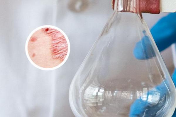 长春银屑病去哪里治疗专业-长春哪个医院治银屑病效果好