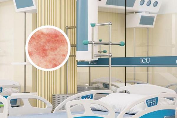 长春看银屑病较好的医院-长春哪个医院治银屑病可以