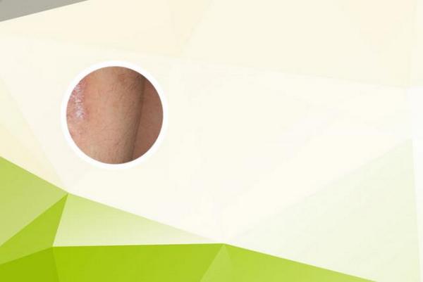 长春哪个医院看银屑病效果好-长春哪里能治银屑病