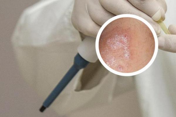 长春好的银屑病医院是哪个医院-可以治疗银屑病的医院长春