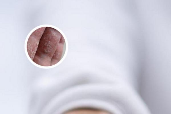 长春博润皮肤病医院好的技术-长春市银屑病医院地址