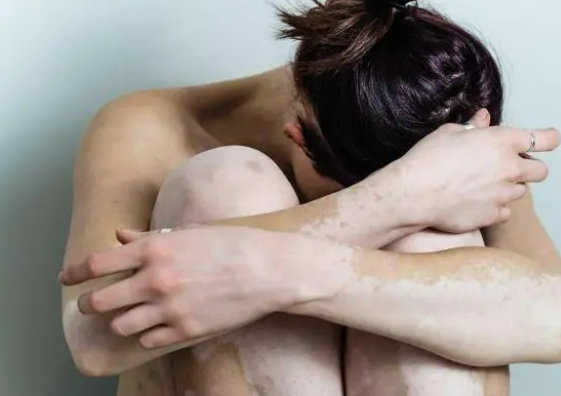 长春专业白癜风医院哪个效果好-长春哪里医院治疗白癜风疗效好