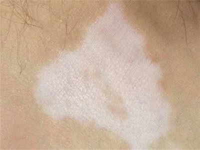 长春白癜风需要治疗吗-长春专业白癜风医院哪个好