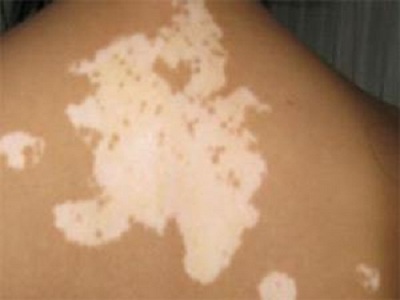 长春博润皮肤病医院好吗-长春哪个医院治白癜风正规