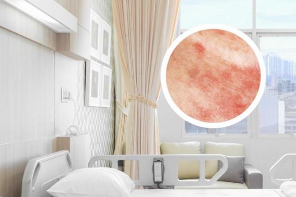 长春治银屑病正规医院-长春专业银屑病医院哪里好