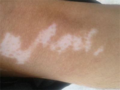 长春博润皮肤病医院广告-长春有哪些治疗白癜风好的医院