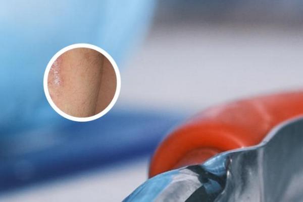 长春什么医院可以治疗银屑病-长春哪个银屑病医院好