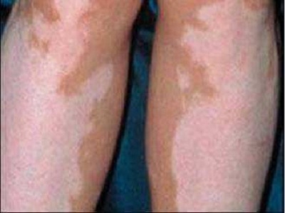 长春白癜风专业医院在哪儿-长春哪家医院白癜风看的好