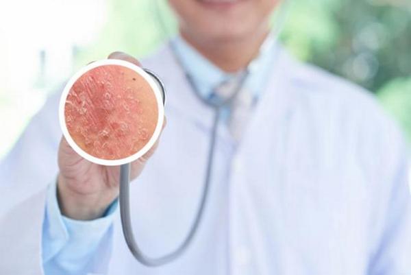 长春看银屑病医院哪里好-长春专门治疗银屑病医院