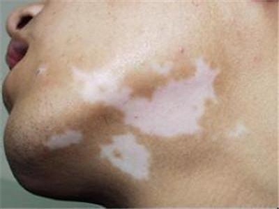 长春治疗白癜风哪个医院好-长春有哪些医院治白癜风效果好