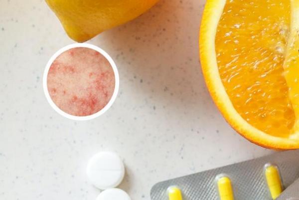 长春哪里有银屑病医院-长春银屑病治疗正规的医院