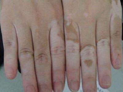 长春治白癜风哪个医院好-长春怎么治疗白癜风