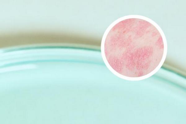 长春哪所医院治疗银屑病效果好-长春银屑病医院查询