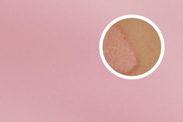 长春看银屑病的医院-长春哪里治银屑病好