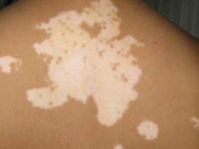 长春好的白癜风专业医院-长春白癜风哪家医院好