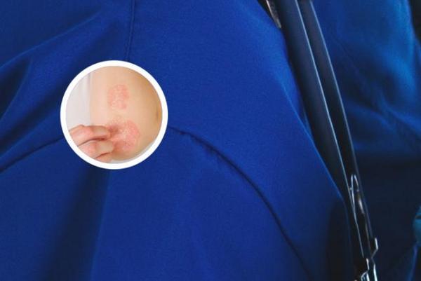 长春哪家医院治银屑病-长春中医看银屑病在哪里