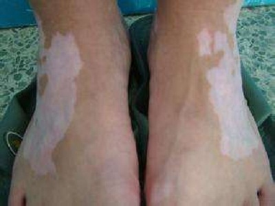 长春哪家医院擅长治疗白癜风-长春治疗脓包型白癜风较好的医院