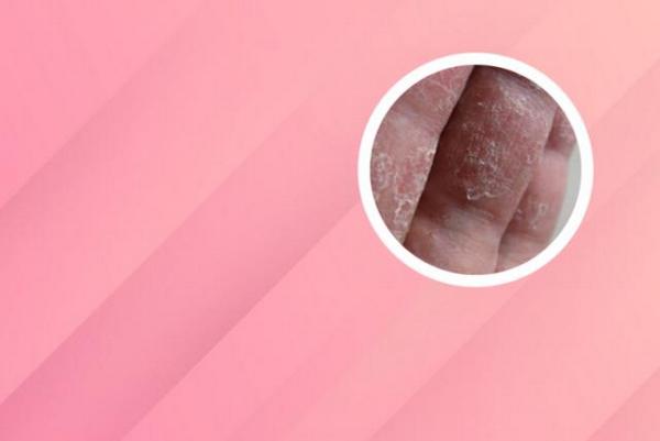 长春治疗白癜风的地址-长春哪个医院治白癜风