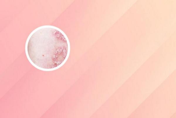 长春哪所医院治疗白癜风可以-长春什么医院治疗白癜风正规