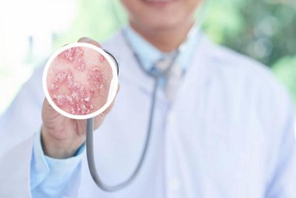 长春银屑病医院哪里好-长春银屑病治疗较好院