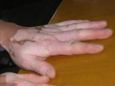 长春专业白癜风医院哪个正规-长春专业白癜风医院怎么去